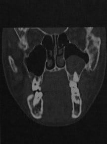 Снимки МРТ и КТ. Одонтогенная киста