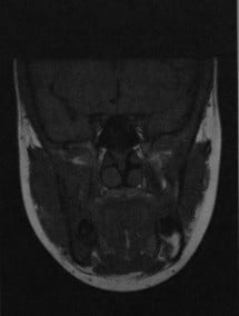 Снимки МРТ и КТ. Остеомиелит нижней челюсти