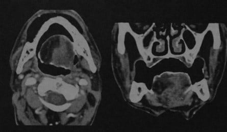 Снимки МРТ и КТ. Односторонняя атрофия мышц