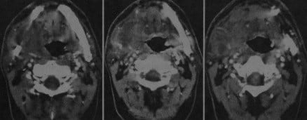 Снимки МРТ и КТ. Абсцесс слюнной железы