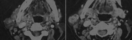Снимки МРТ и КТ. Лимфома слюнных желез