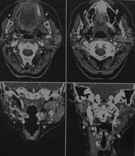 Снимки МРТ и КТ. Лимфома слюнных желез