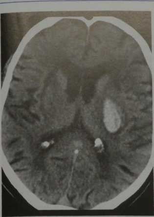 Снимки МРТ и КТ. Первичное внутримозговое кровоизлияние