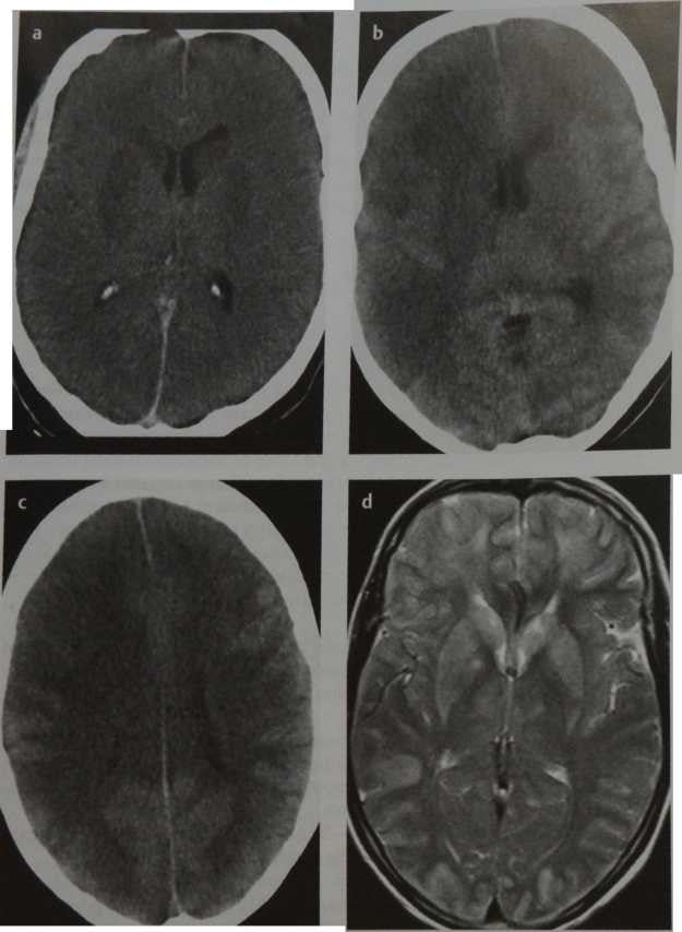 Снимки МРТ и КТ. Диффузное гипоксическое повреждение головного мозг