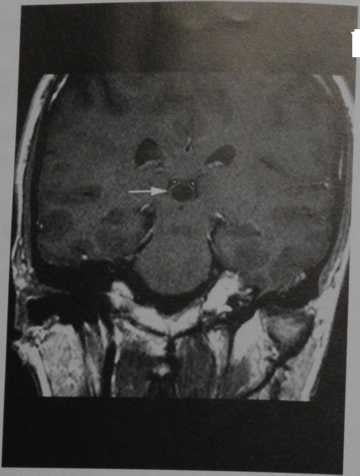 Снимки МРТ и КТ. Киста шишковидной железы
