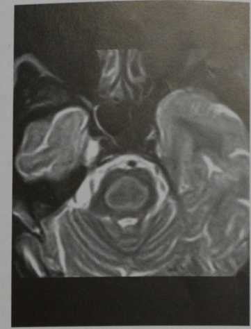 Снимки МРТ и КТ. Центральный понтинный миелинолиз