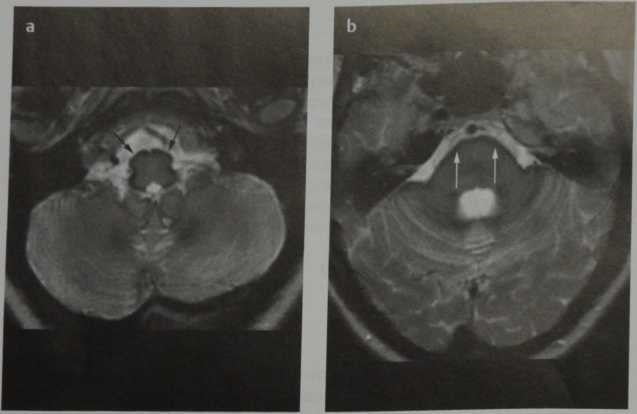 Снимки МРТ и КТ. Поверхностный сидероз головного мозга