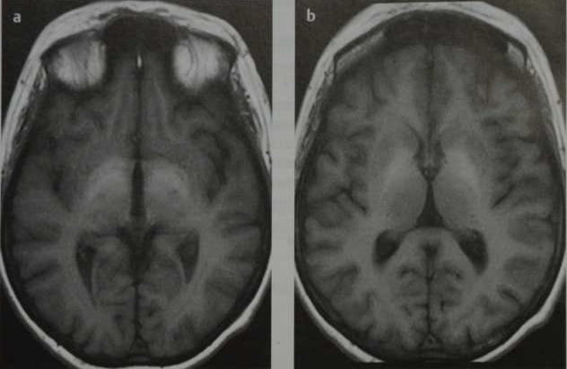 Снимки МРТ и КТ. Печеночная энцефалопатия