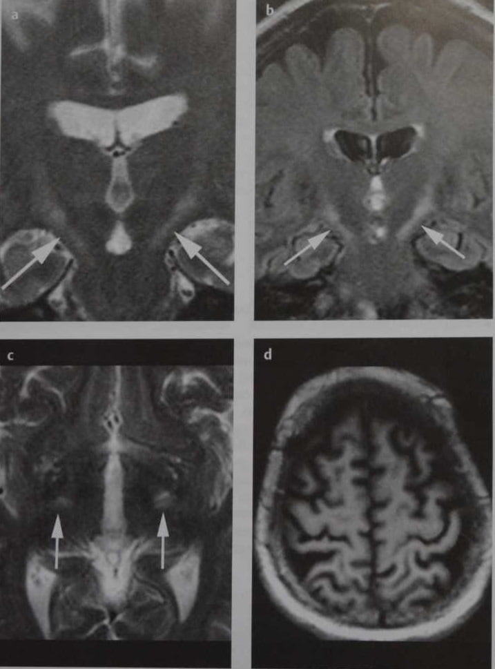 Снимки МРТ и КТ. Боковой амиотрофический склероз (БАС)