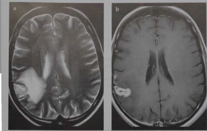 Снимки МРТ и КТ. Токсические лейкоэнцефалопатии