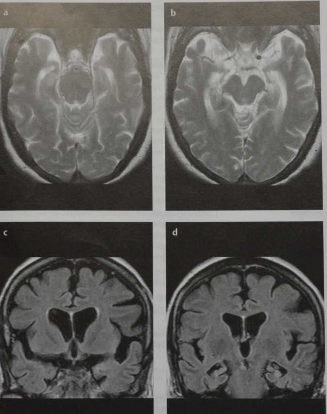 Снимки МРТ и КТ. Болезнь Альцгеймера