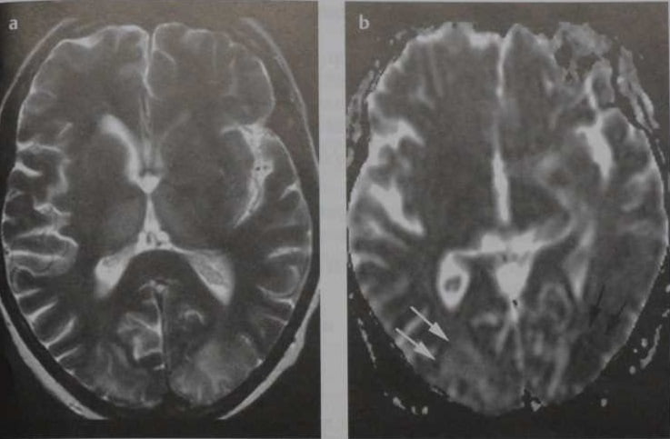 Снимки МРТ и КТ. Обратимая лейкоэнцефалопатия вертебробазилярного б