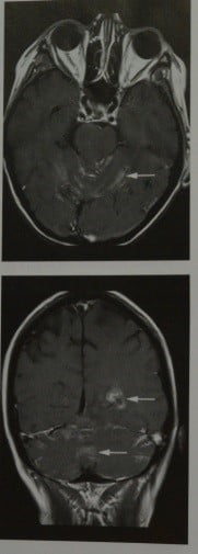 Снимки МРТ и КТ. Карциноматоз мозговых оболочек