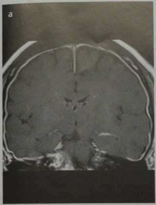 Снимки МРТ и КТ. Реактивное контрастное усиление мозговых оболочек