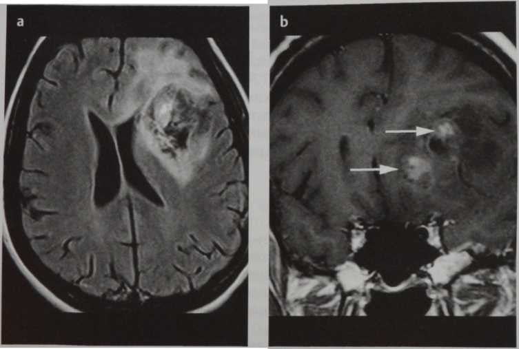 Снимки МРТ и КТ. Олигодендроглиома