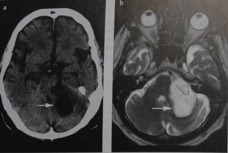 Снимки МРТ и КТ. Эпидермоидная киста головного мозга
