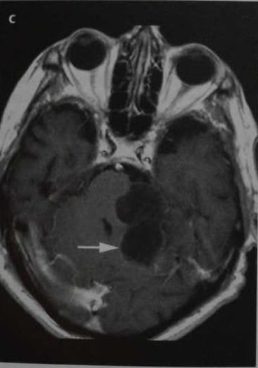 Снимки МРТ и КТ. Эпидермоидная киста головного мозга