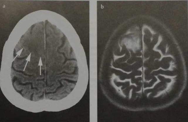 Снимки МРТ и КТ. Астроцитома низкой степени анаплазии