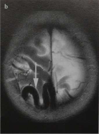 Снимки МРТ и КТ. Пиальная артериовенозная мальформация (ПАМ)