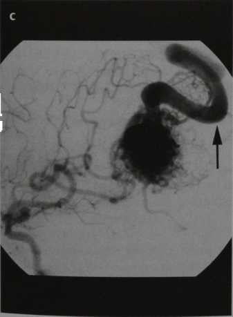 Снимки МРТ и КТ. Пиальная артериовенозная мальформация (ПАМ)