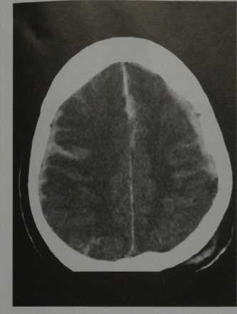 Снимки МРТ и КТ. Травматическое субарахноидальное кровоизлияние