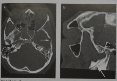 Снимки МРТ и КТ. Перелом костей черепа