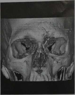 Снимки МРТ и КТ. Перелом костей черепа