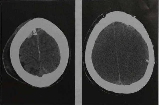 Снимки МРТ и КТ. Отек головного мозга