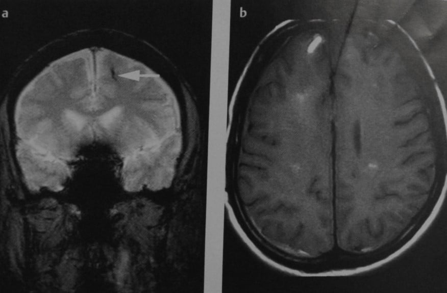 Снимки МРТ и КТ. Диффузное аксональное повреждение