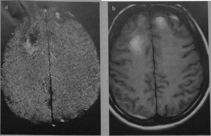 Снимки МРТ и КТ. Ушиб головного мозга