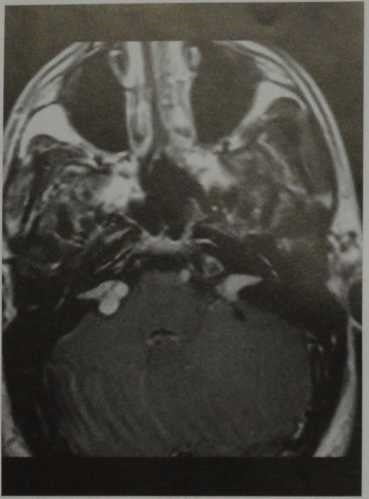 Снимки МРТ и КТ. Нейрофиброматоз II типа - врожденная мальформация