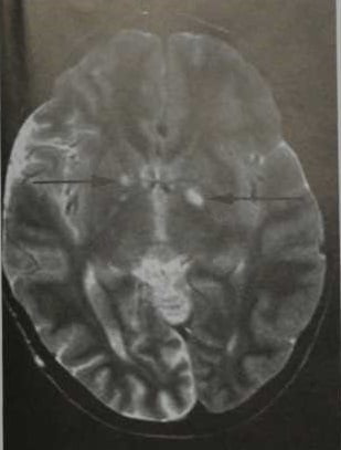 Снимки МРТ и КТ. Нейрофиброматоз I типа (болезнь Реклингхаузена)