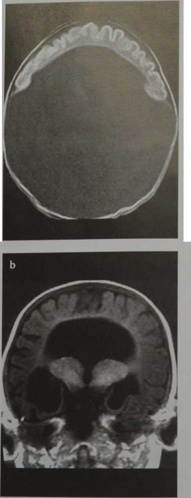 Снимки МРТ и КТ. Голопрозэнцефалия