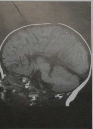 Снимки МРТ и КТ. Аномалии мозолистого тела