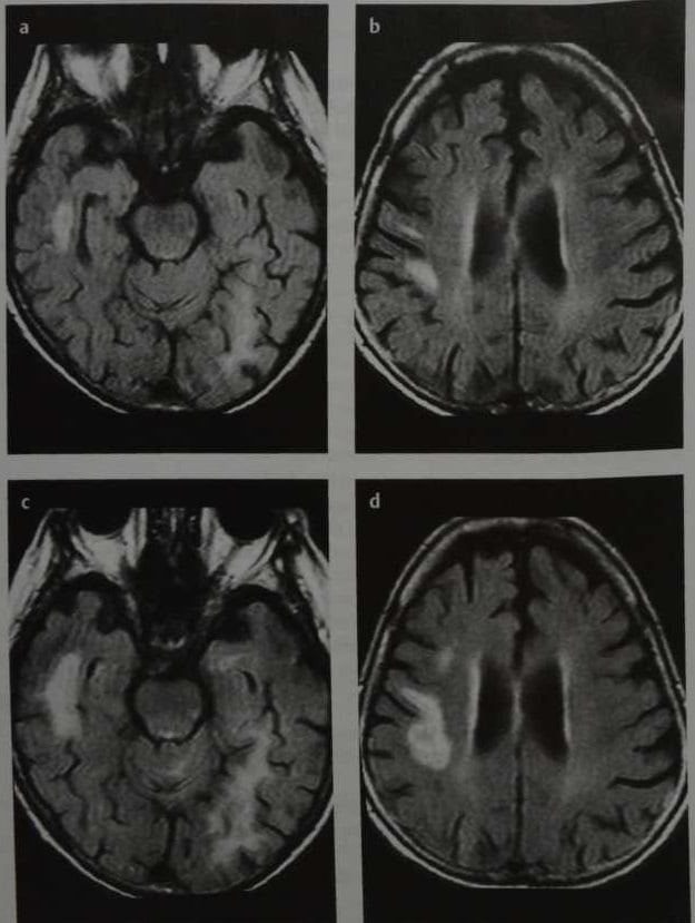 Снимки МРТ и КТ. Прогрессирующая мультифокальная лейкоэнцефалопатия