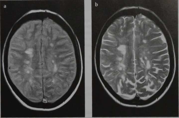 Снимки МРТ и КТ. Рассеянный склероз (РС)
