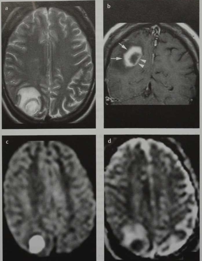 Снимки МРТ и КТ. Абсцесс головного мозга