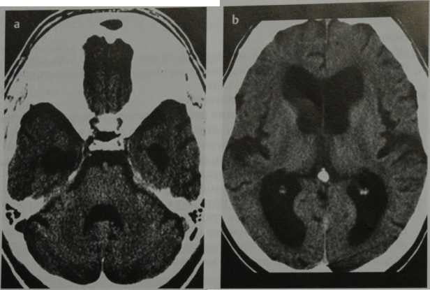 Снимки МРТ и КТ. Идиопатическая нормотензивная гидроцефалия