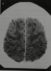 Снимки МРТ и КТ. Идиопатическая нормотензивная гидроцефалия