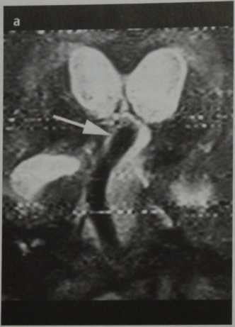 Снимки МРТ и КТ. Окклюзионная гидроцефалия