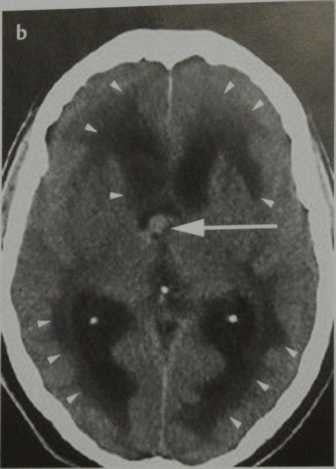 Снимки МРТ и КТ. Окклюзионная гидроцефалия