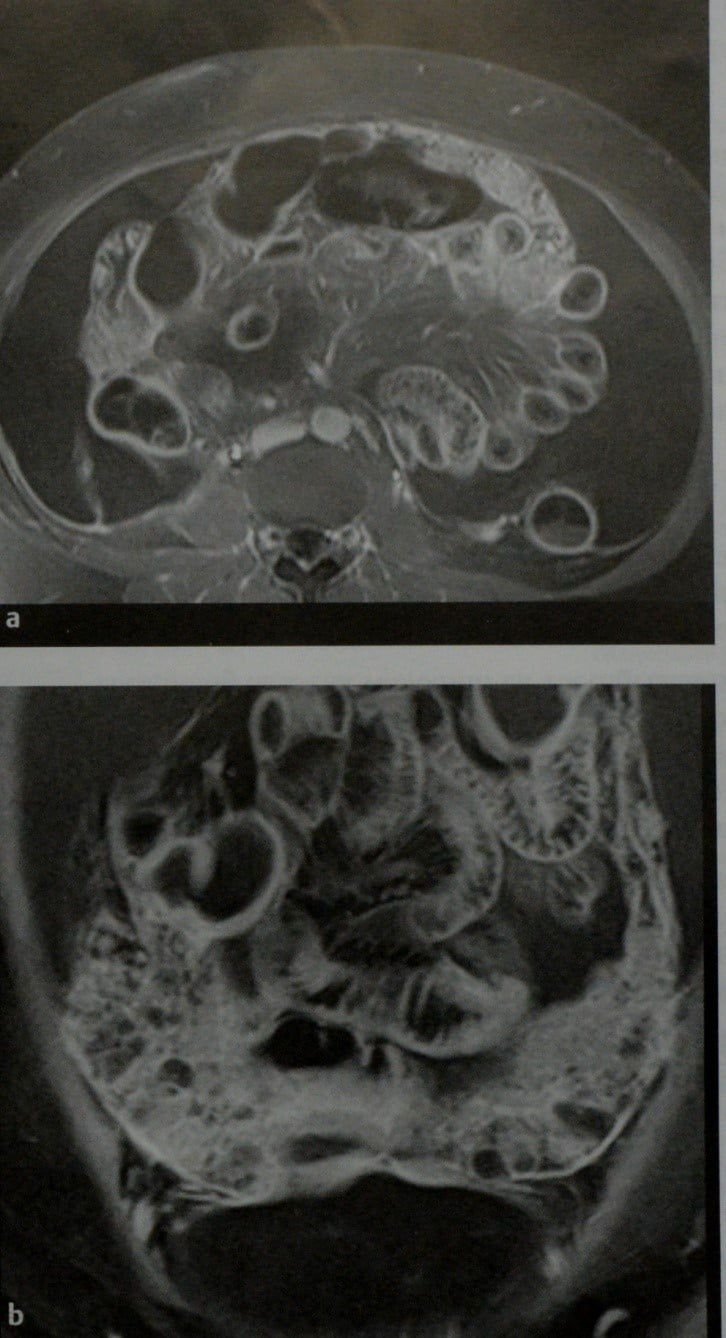 Снимки МРТ и КТ. Карциноматоз брюшины