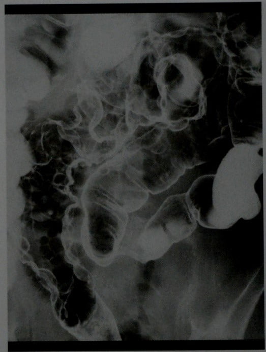 Снимки МРТ и КТ. Пневматоз кишечника