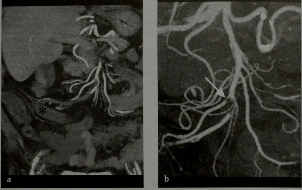Снимки МРТ и КТ. Острая ишемия брыжейки