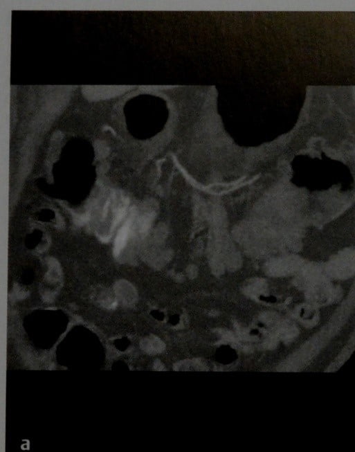 Снимки МРТ и КТ. Желудочно кишечное кровотечение