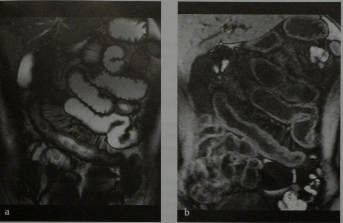 Снимки МРТ и КТ. Болезнь Крона