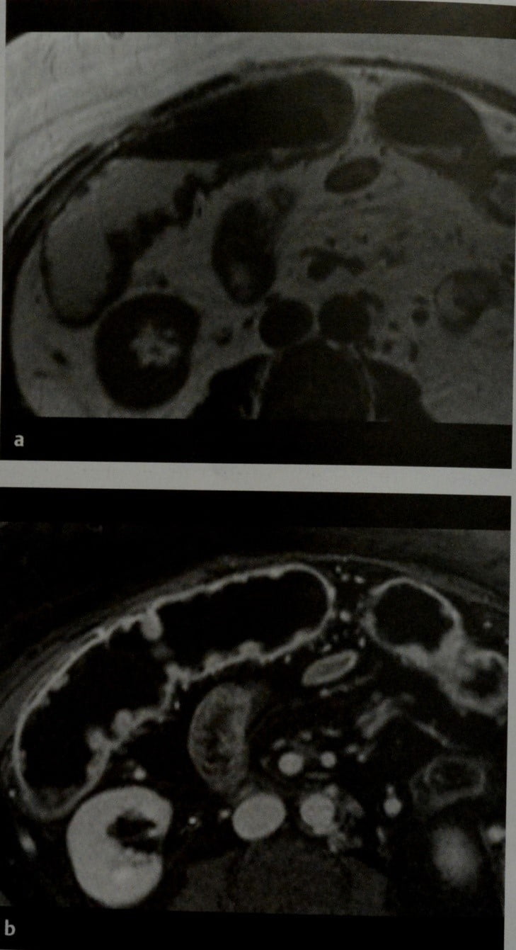Снимки МРТ и КТ. Язвенный колит