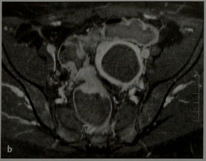 Снимки МРТ и КТ. Эндометриоз кишечника