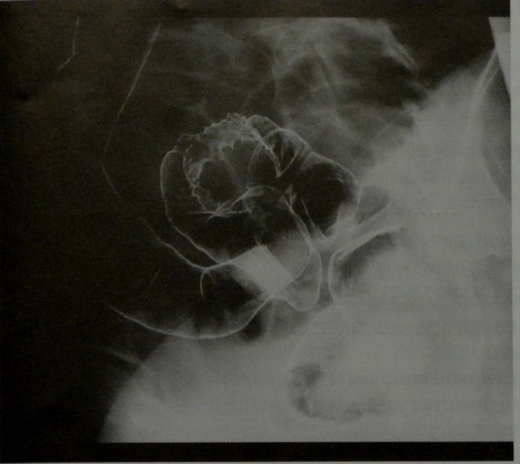 Снимки МРТ и КТ. Эндометриоз кишечника
