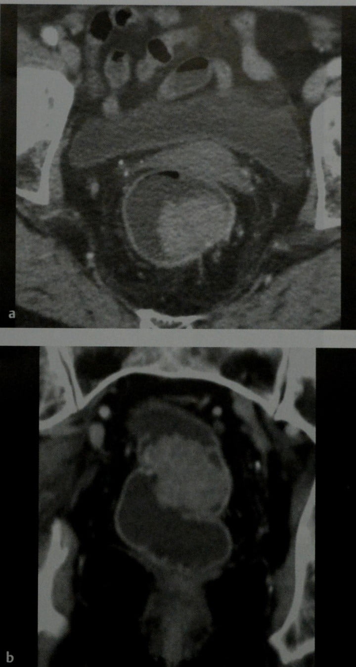 Снимки МРТ и КТ. Рак прямой кишки